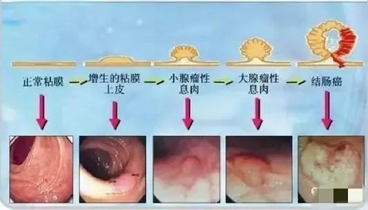 肠长了息肉有什么症状,肠里有息肉是怎么造成的