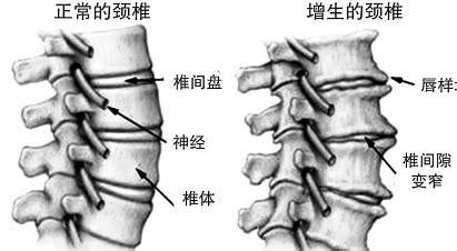 骨刺骨质增生图片大全,骨质增生与骨刺是不是同类病名