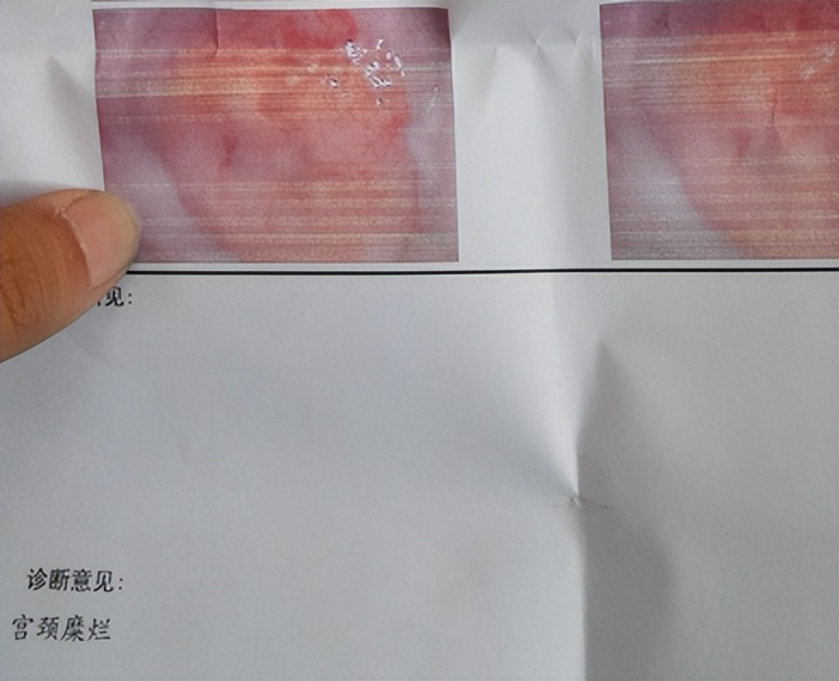 女子下身检查疼痛难忍,女性突然腹痛查出盆腔出血