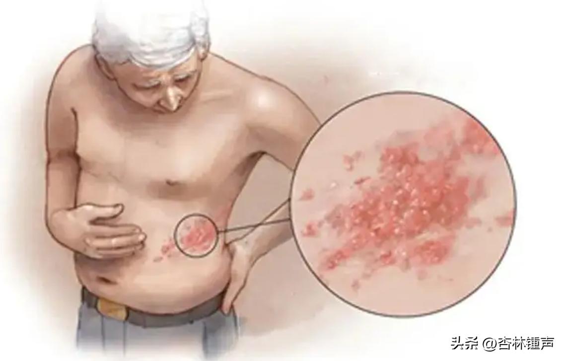 带状疱疹是什么样的怎么治,带状疱疹长在眼睛附近要特别注意