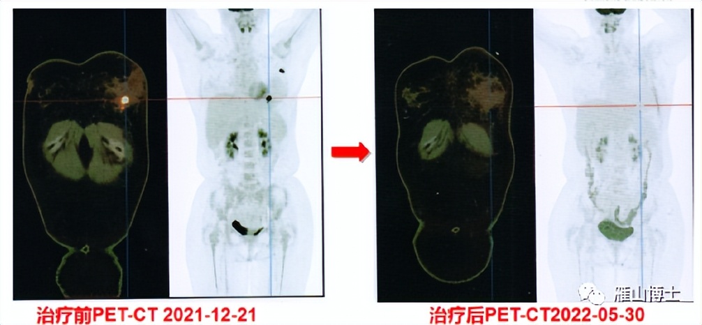 乳腺癌发现早可以用药物解决吗,面对乳腺癌的正确方法