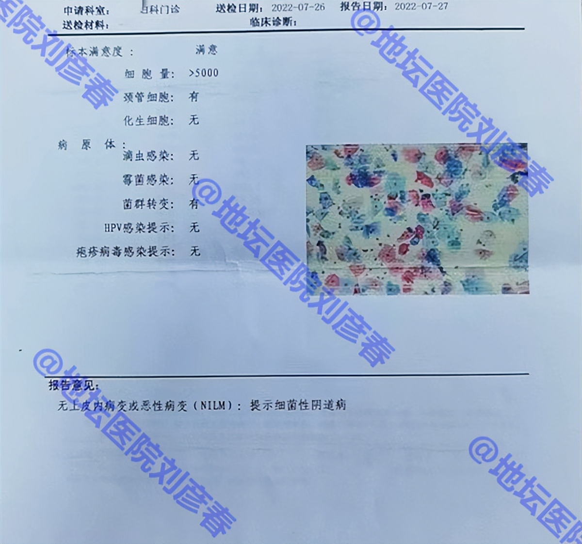 为什么tct正常而活检有癌前病变,为什么tct异常不会显示宫颈炎