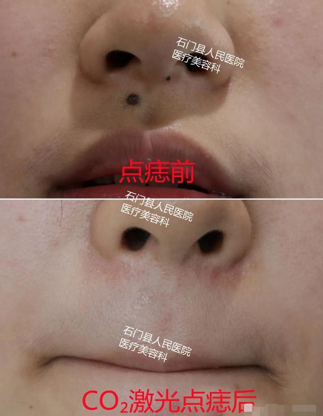 美丽无需“痣”疑！有痣别乱点，这些方法最靠谱