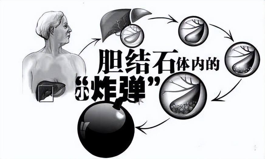 胆囊有结石建议摘除还是保胆取石,胆囊结石需要查肝功能吗