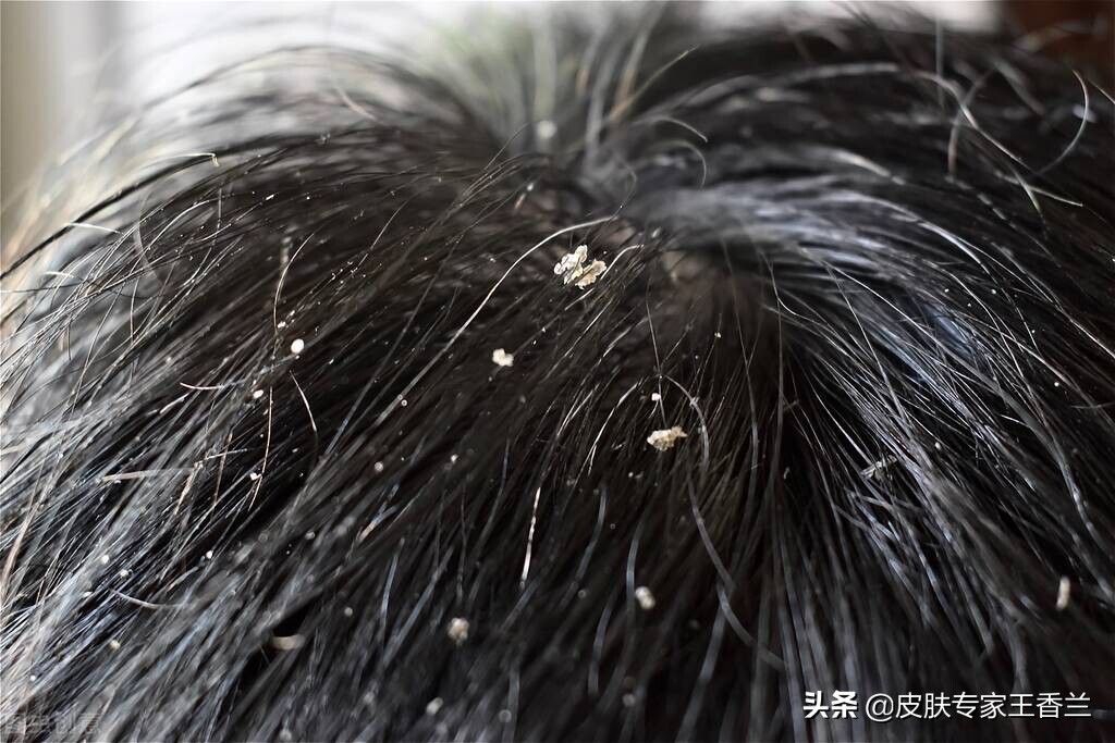 炉甘石洗剂对皮肤瘙痒有效果吗,炉甘石洗剂治疗糖尿病皮肤瘙痒