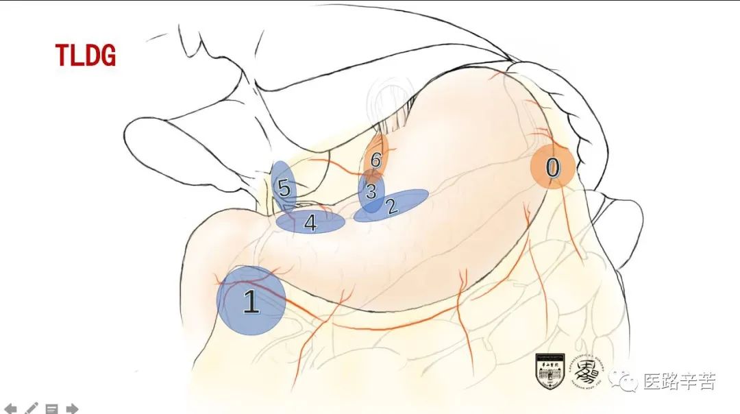 全腹腔镜胃癌根治术，学习大咖怎么清扫淋巴结