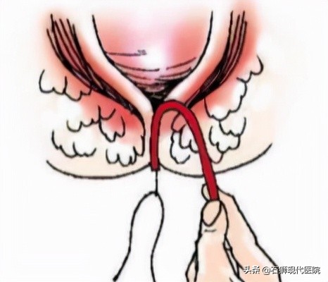 肛周湿疹瘙痒怎么治彻底,肛周湿疹痒得特别厉害怎么办