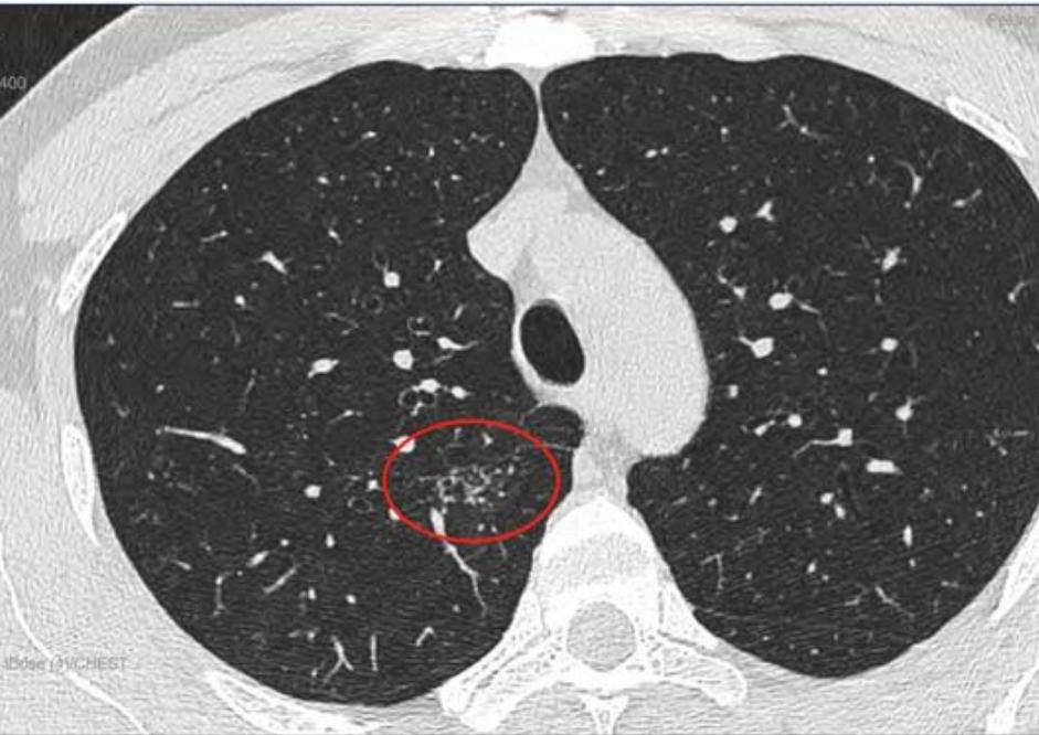 磨玻璃结节9*8mm建议随访,8mm磨玻璃结节一年没长