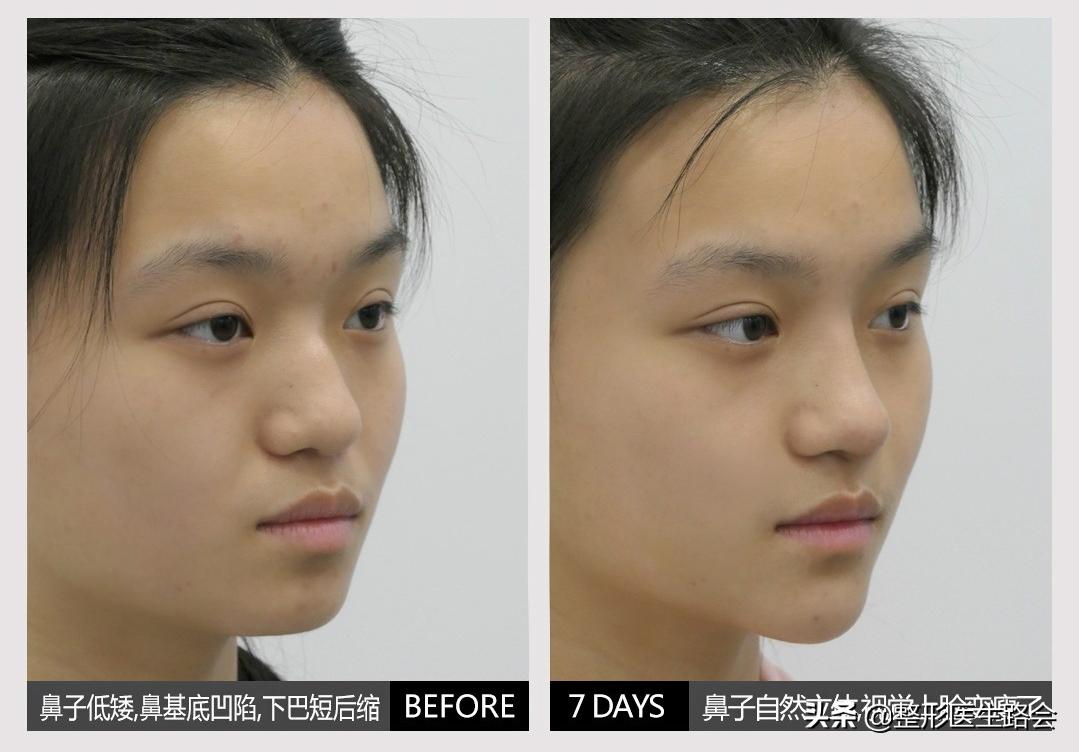 全脸整形记录恢复过程,女孩整形全过程