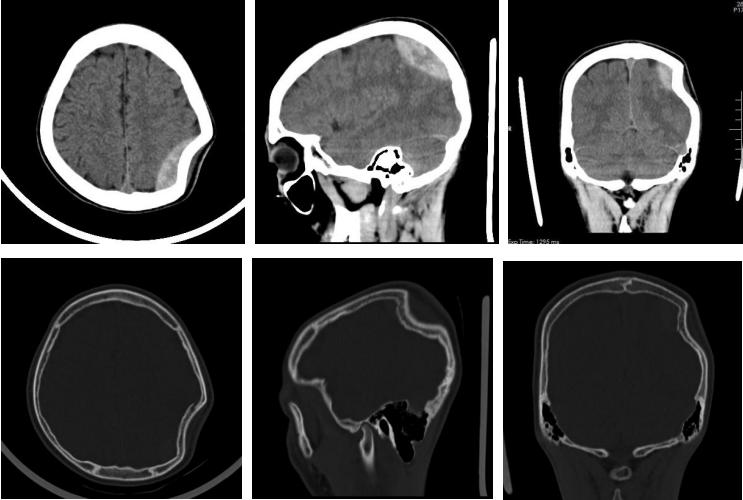 飞来横祸轮胎砸中脑袋,一男孩被铅球砸严重骨折