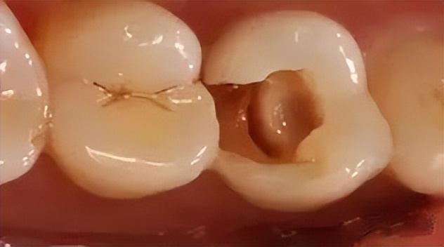 补牙跟嵌体有什么区别哪个更牢固,补牙为什么非要根管