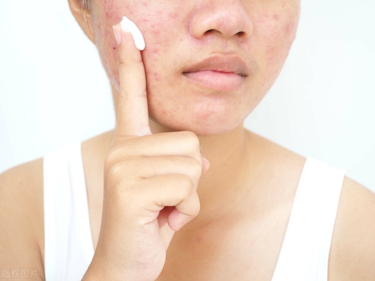 阳康之后，痘痘一个劲往外冒，好想挤掉，怎么办