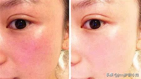 脸部红血丝怎么去除最好的方法,脸部红血丝怎么去除小妙招视频