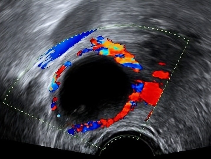 超声显示子宫肌瘤卵巢囊肿,显微镜下的卵巢囊肿