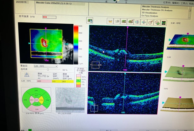 激光视力矫正危害,警惕激光笔对眼睛的损伤