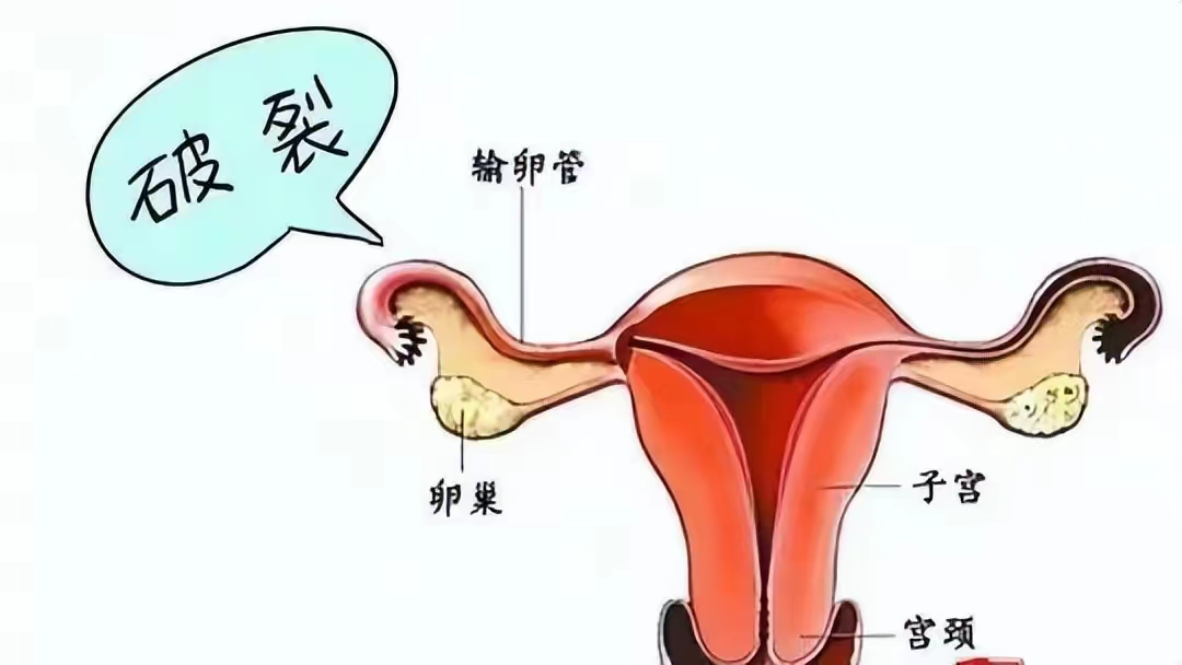 同房后酿成的悲剧:黄体破裂，夫妻生活不是打仗，要适度