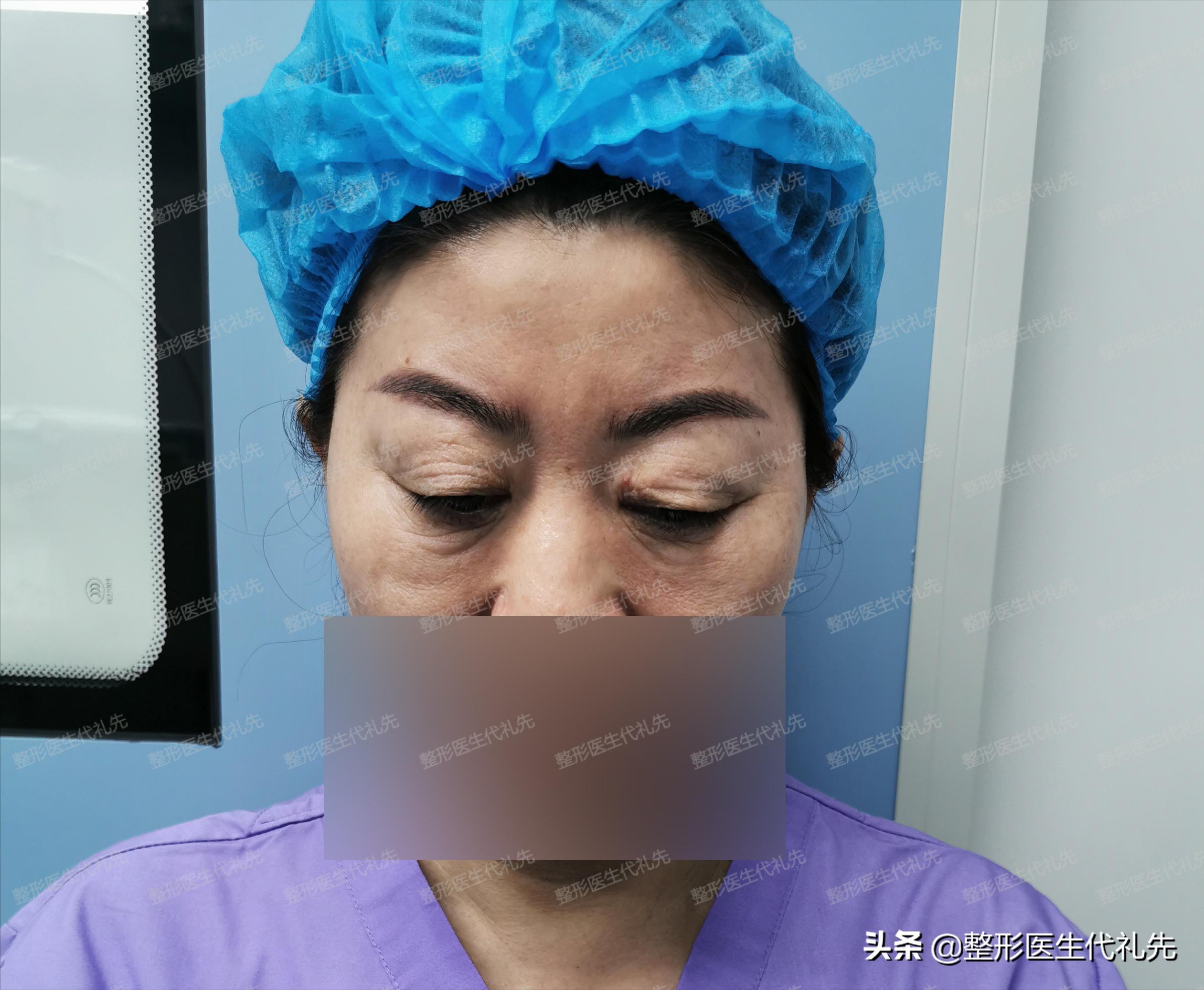 全切双眼皮5个月修复调整全过程,全切双眼皮个人恢复过程经历真实