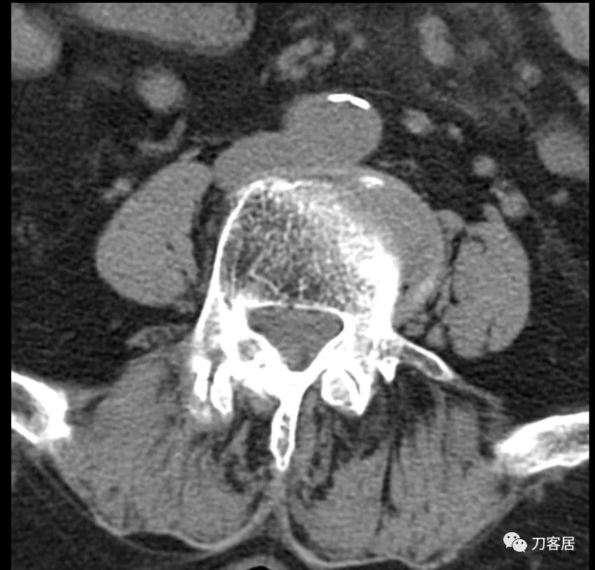 老年人腰骨裂不手术怎么治疗最好,老年腰椎骨质疏松症
