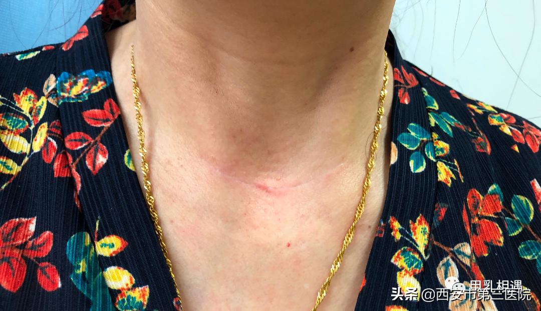 做甲状腺手术后瘢痕怎么描述,疤痕体质甲状腺手术后疤痕怎么办