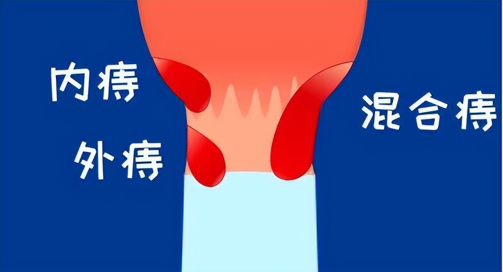 痔疮站不得坐不得，面对如此痛苦我该怎么办？