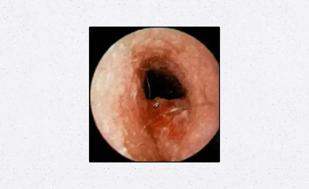 总是抠耳洞很痒怎么办,刚打的耳洞痒痒老想抠怎么办