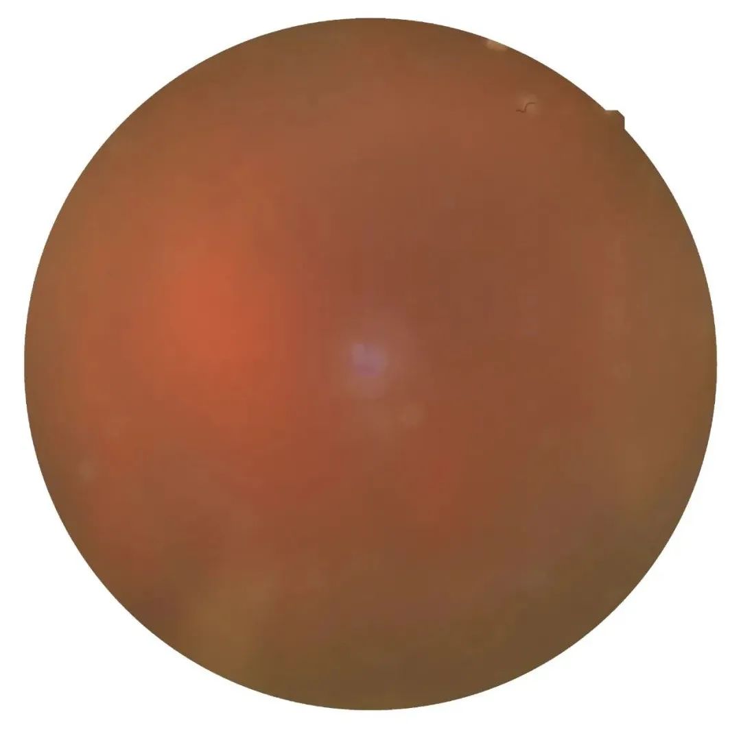 眼底出血术后忌什么中药,眼底出血中医有好办法吗