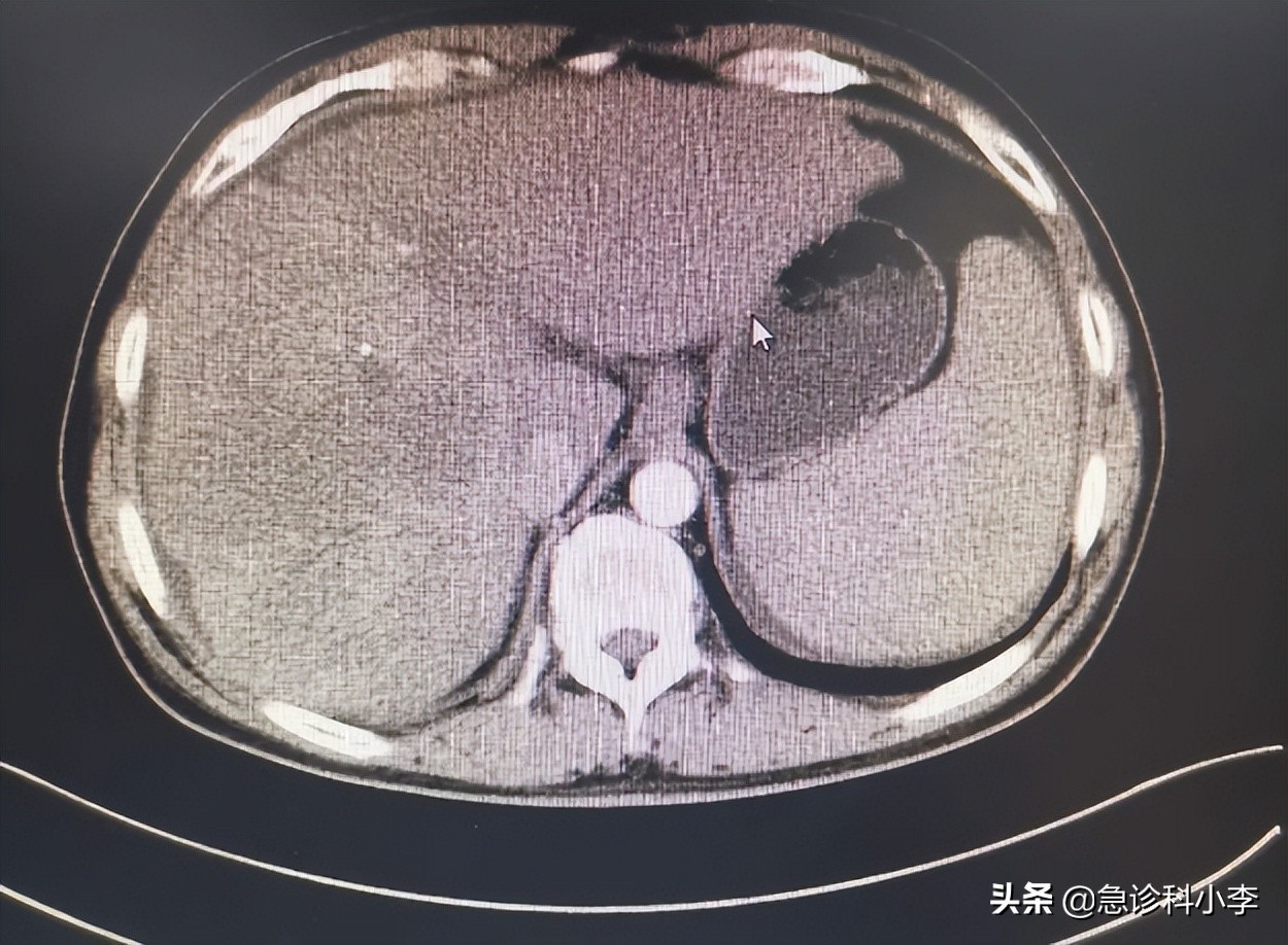 28岁小伙频繁腹痛一查竟是肝癌,70岁大爷腹痛难忍医生一看ct