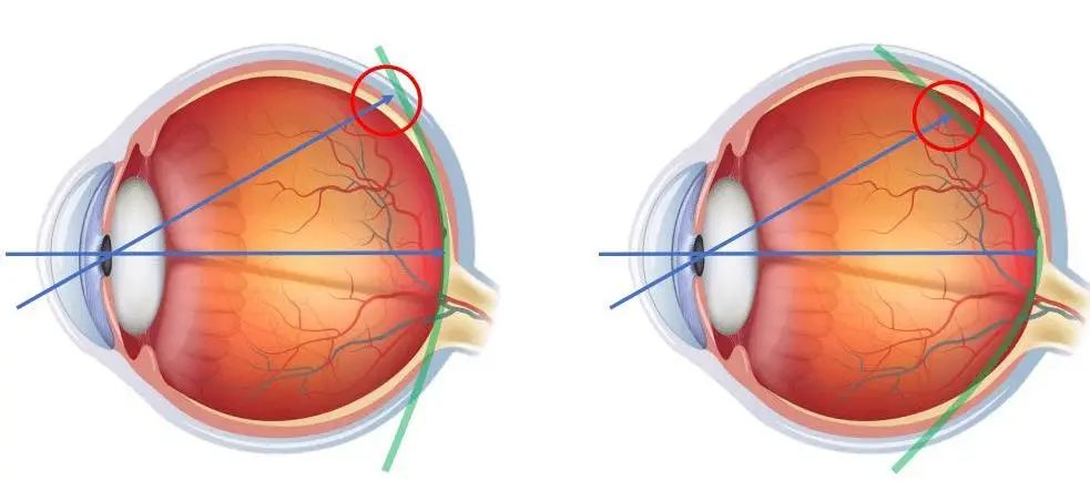 近视了不能矫正到1.0为啥视力模糊,近视矫正后遗症会一直存在吗