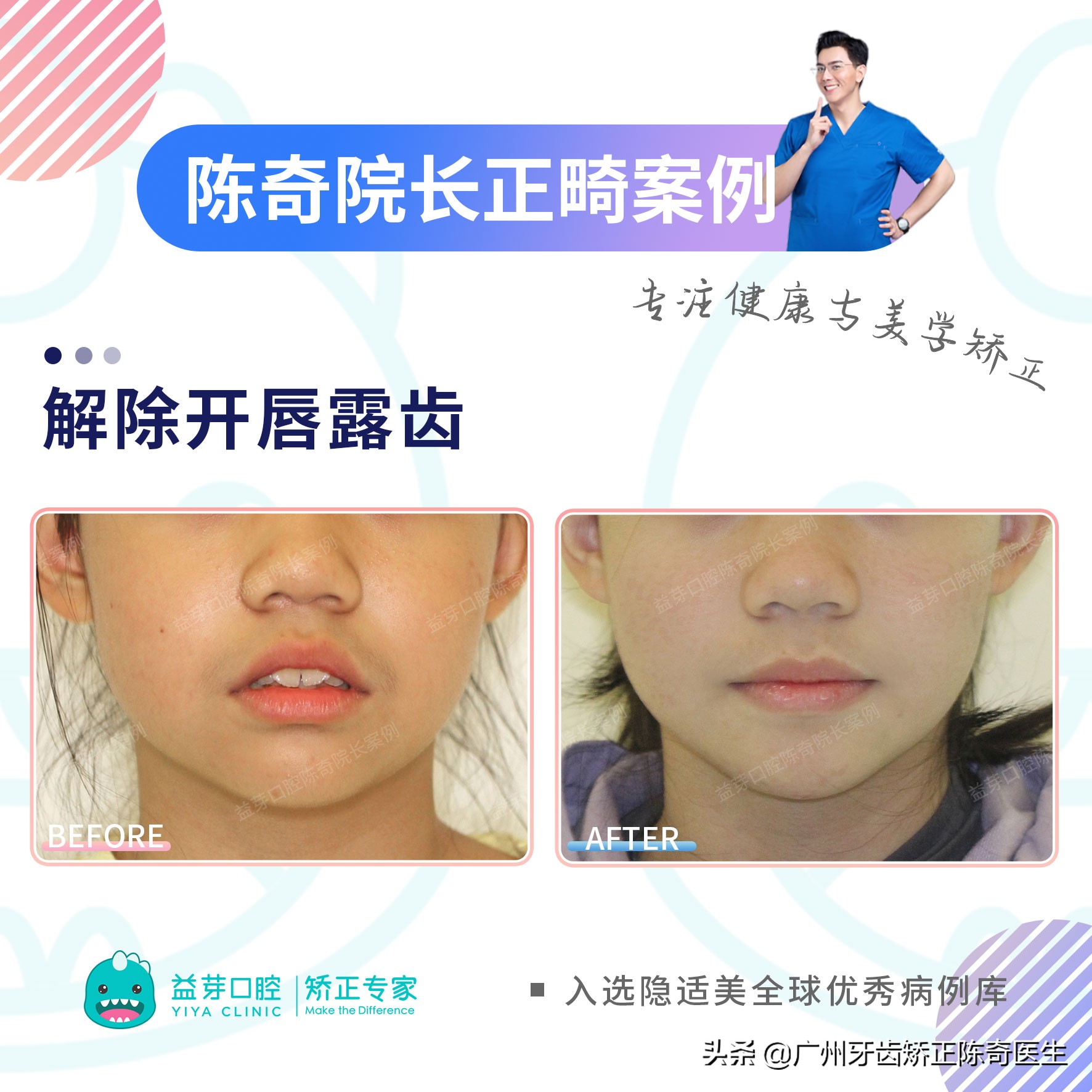 11岁女孩牙齿前突需要扩弓吗,16岁女生上颌骨前突矫正