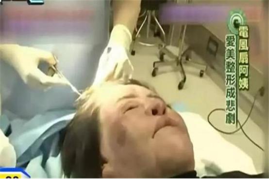 韩国“电风扇大妈”：为变美整容，给自己注射大豆油，用石蜡填充