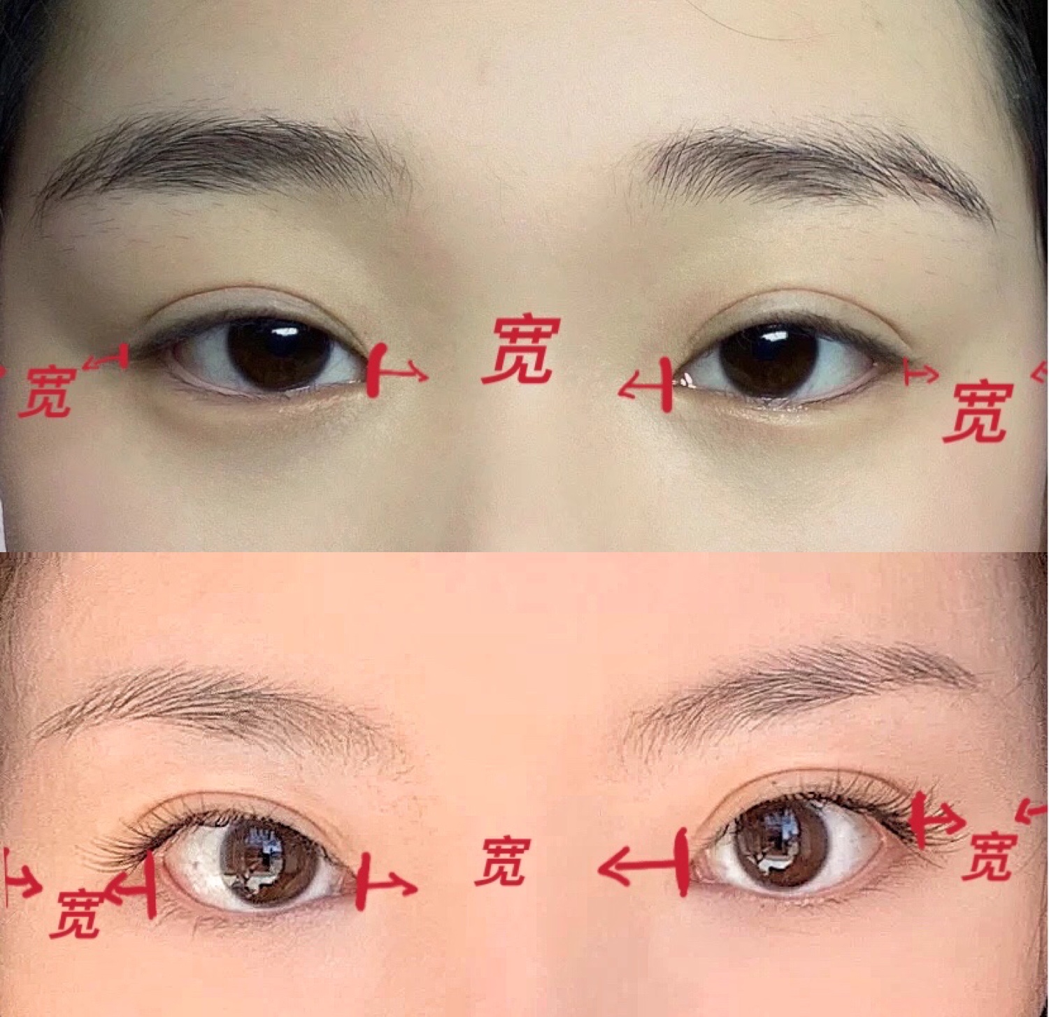 整形科普知识修复双眼皮,双眼皮整形有哪些常见方法