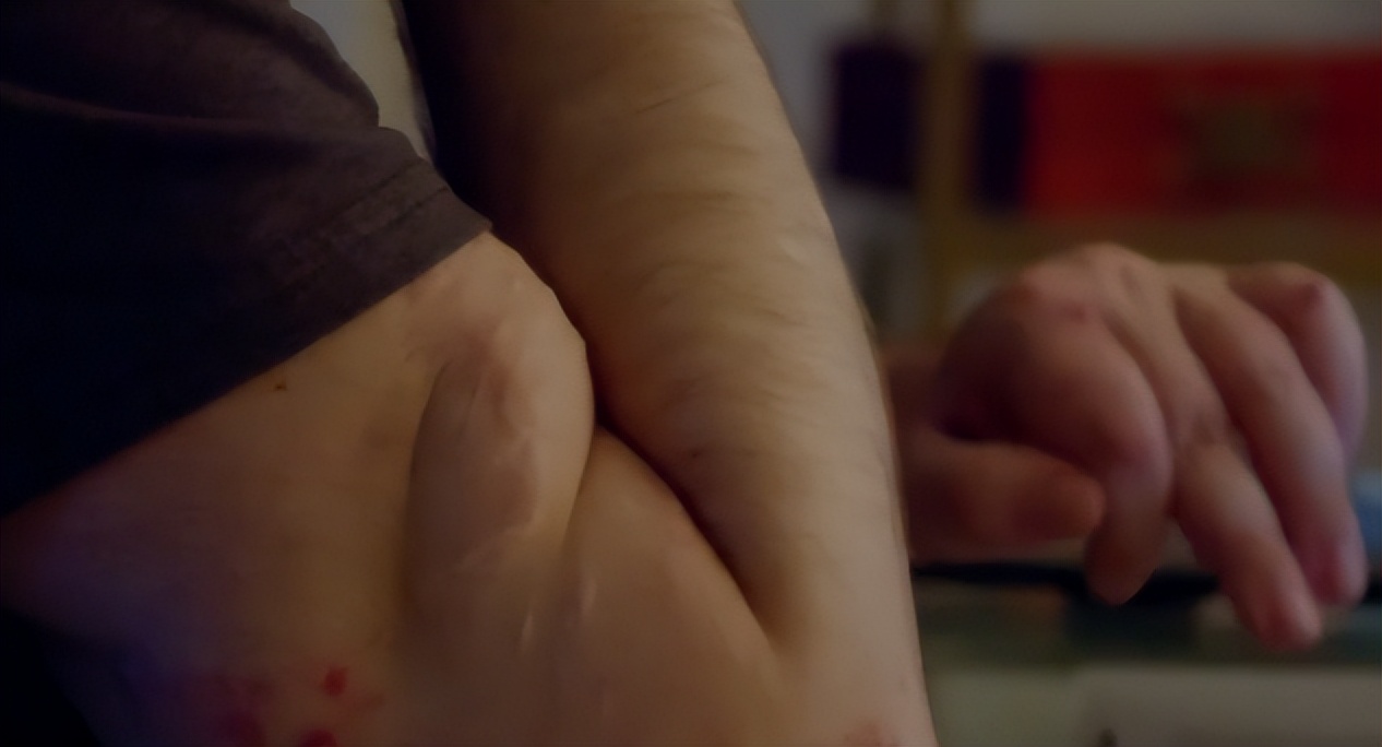 不得不承认美国医术很强：双手被炸断了6年，竟移植他人手臂复活