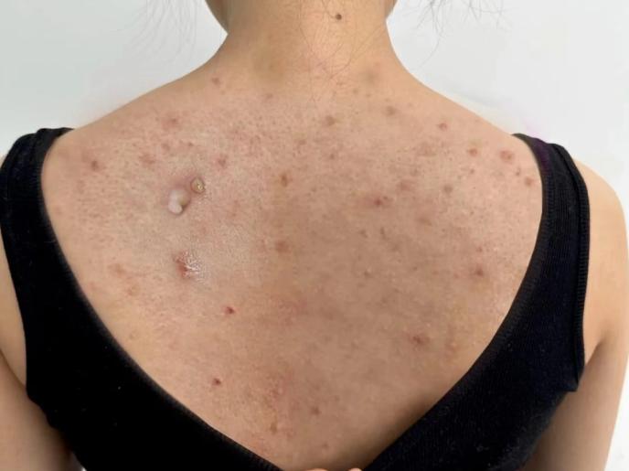 后背生疮是什么原因引起的,后背痤疮发痒怎么办