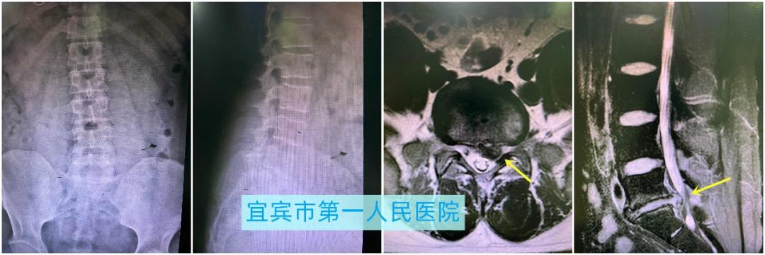 腰椎康复在家自我疗法,腰椎微创康复