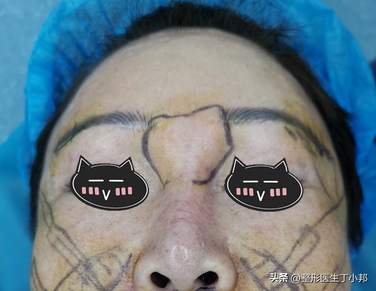 注射隆鼻材料取出难吗,打了玻尿酸填充鼻基底有异物感