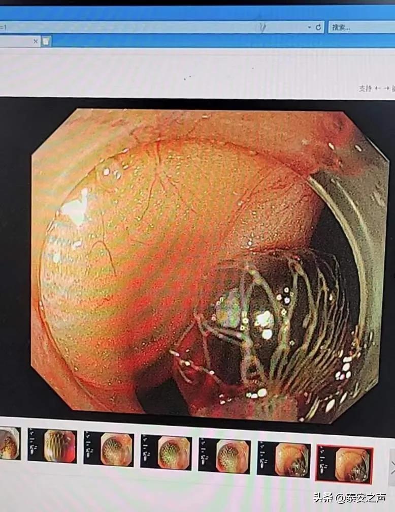 惊了！保胆取石取出164枚结石！这个团队是怎么做到的