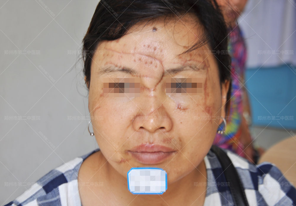 郑州市第二中医院治疗疤痕靠谱吗,郑州第二中医院治疤痕多少钱