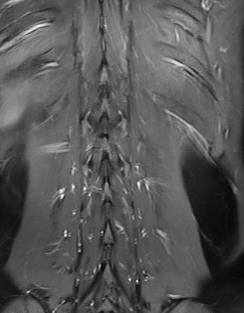脊柱多发血管瘤手术指征,椎管内良性肿瘤有哪些