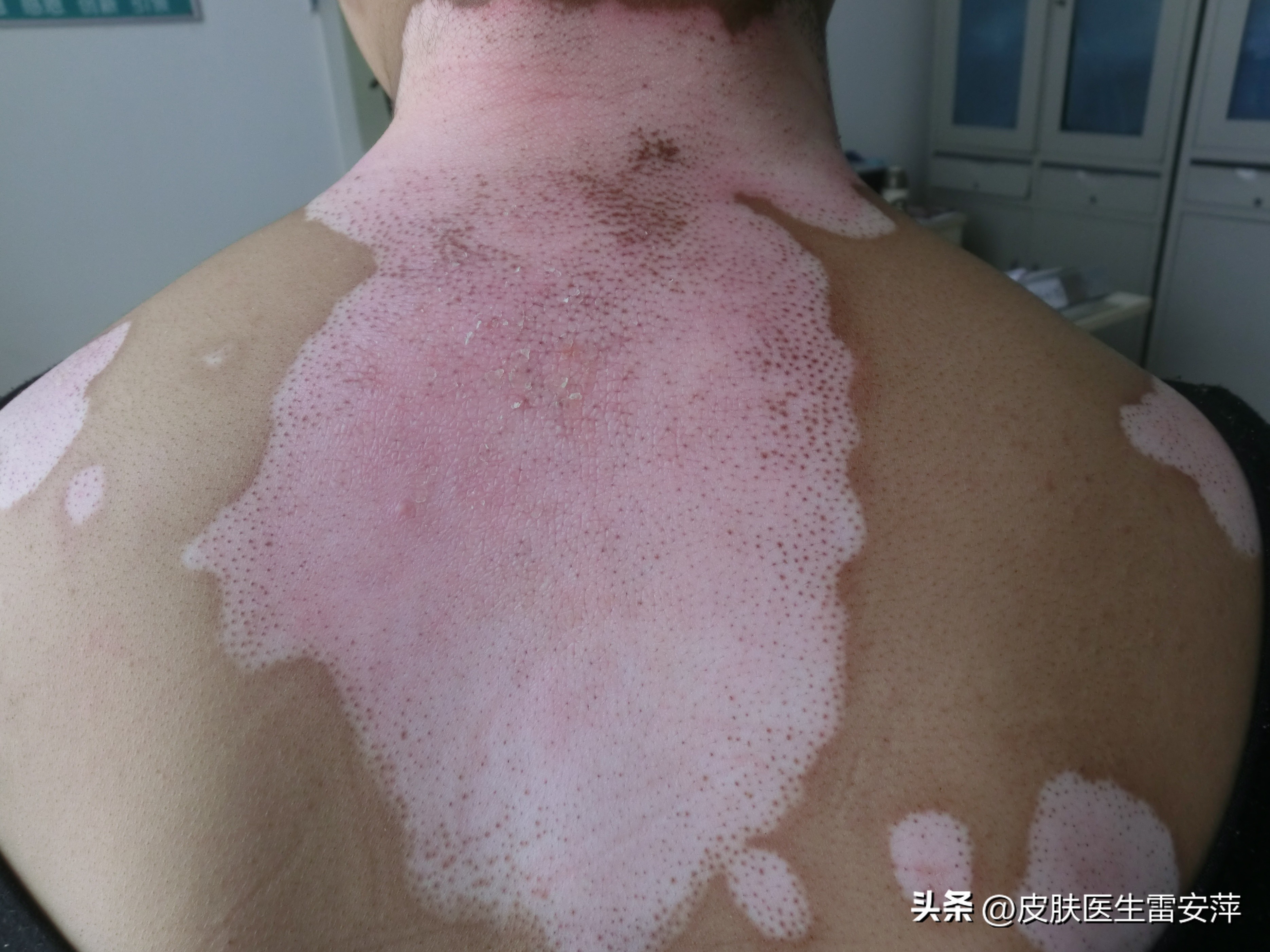 皮肤上突然黄了一块,突然有块地方变白是白癜风吗