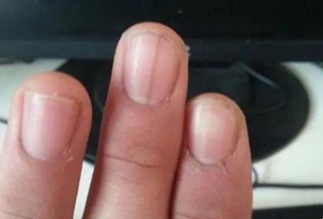 指甲竖纹多是什么原因怎样治疗,指甲竖纹好严重怎么调理