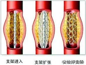 大连中医治疗下肢动脉硬化闭塞症,警惕动脉硬化的杀手