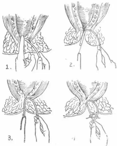 肛门疼有炎症吃什么药,肛门脓肿太疼吃什么药