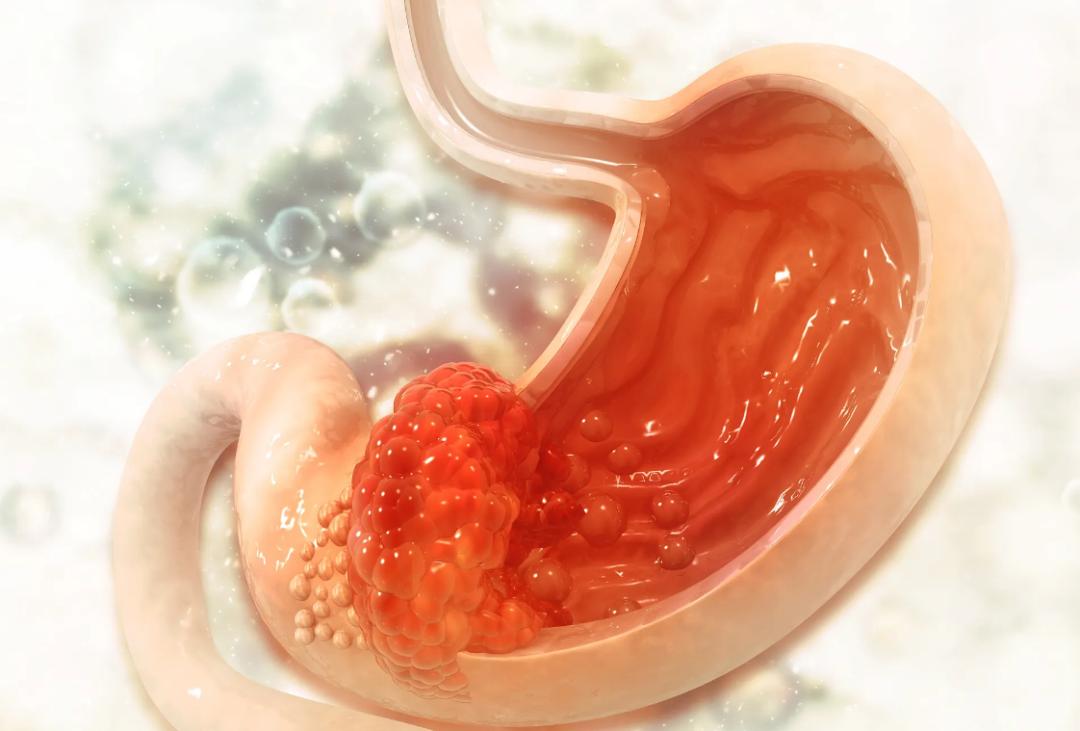 长息肉是癌症的前兆吗,体检查出有很小的息肉怎么办