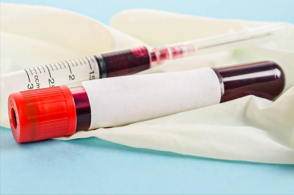 发现尿蛋白有什么中成药能治疗,发现尿蛋白1+还有红细胞