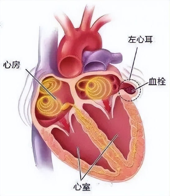 76岁老人心脏房颤是怎么引起的,80多岁老人持续房颤意味着啥