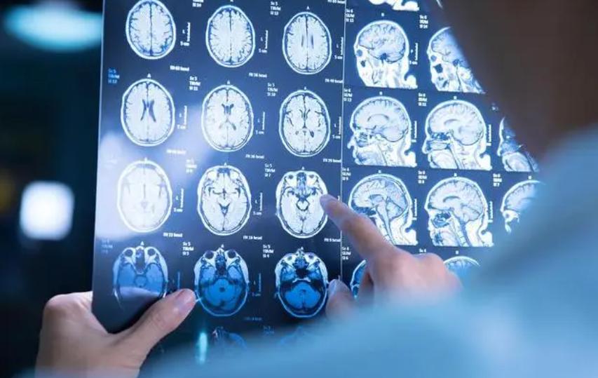 大脑萎缩严重时会产生什么后果,大脑在慢慢的萎缩是什么症状