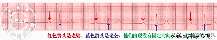 护考几种常见的心电图,常见的心电图图形分析