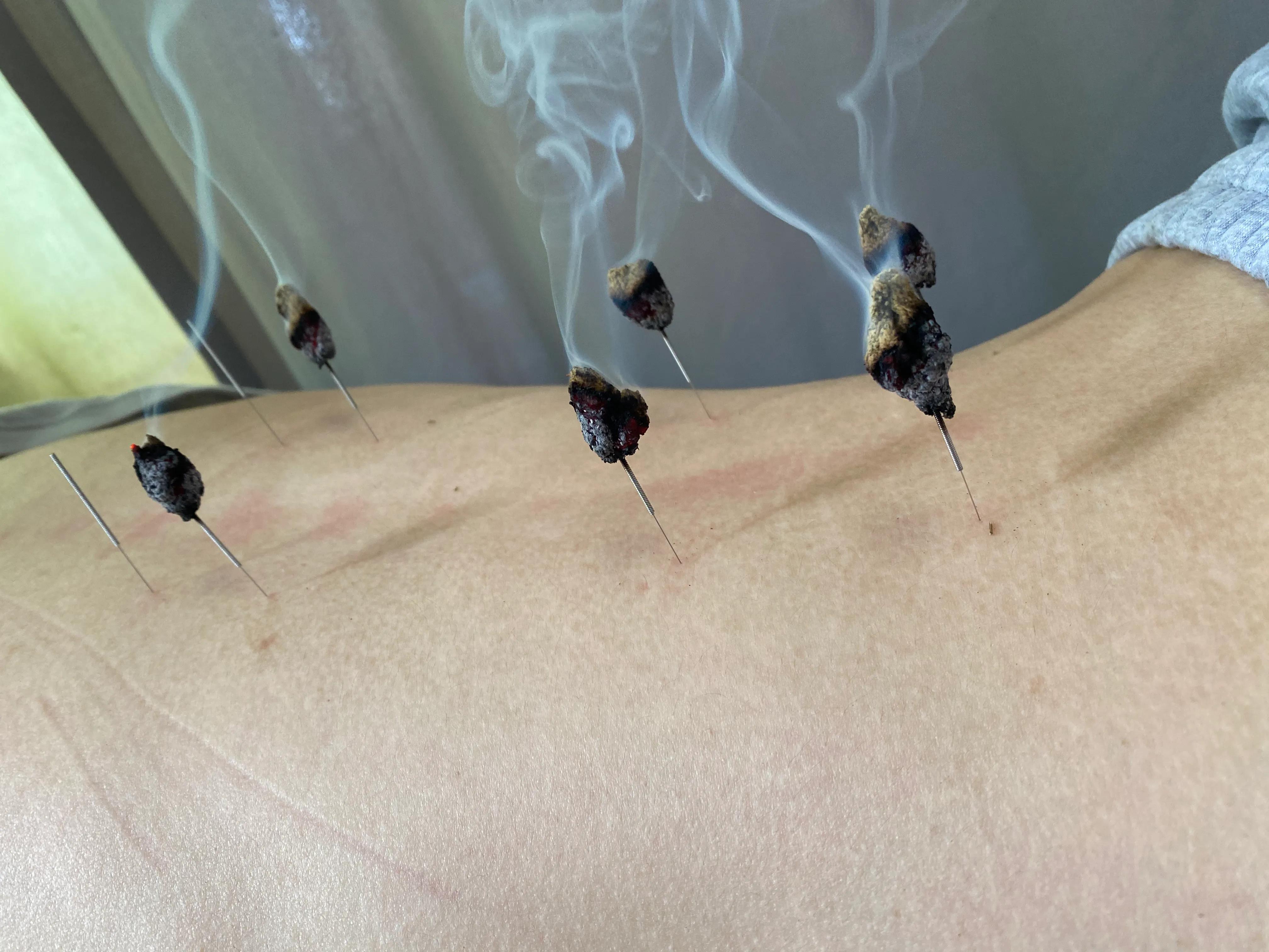 腰腿痛针灸特效穴,针灸针刀治疗腰腿痛