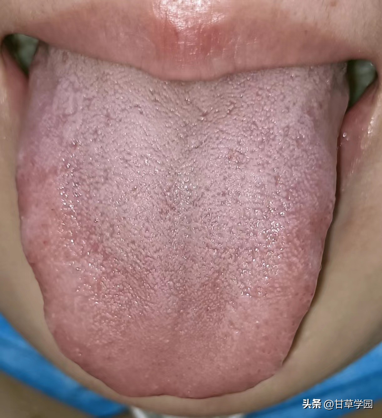 甘草学园|【思考】治疗乙肝、多囊得到明显缓解