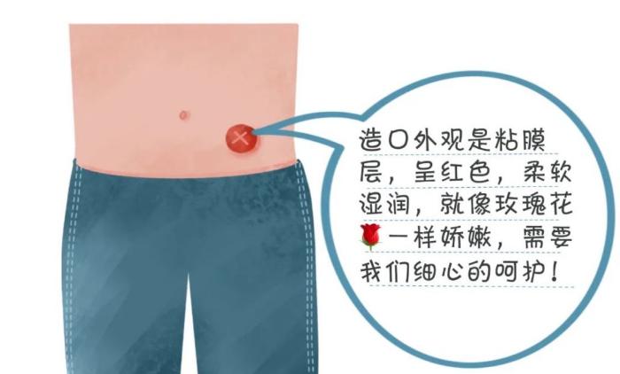 【收藏】肠造口术后护理，家有肠造口宝宝速来领取